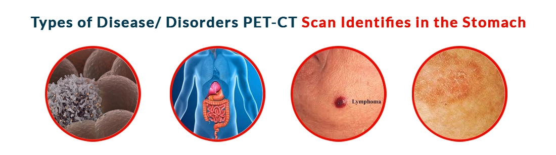 Types of Disease Disorders PET-CT Scan Identifies in the Stomach
